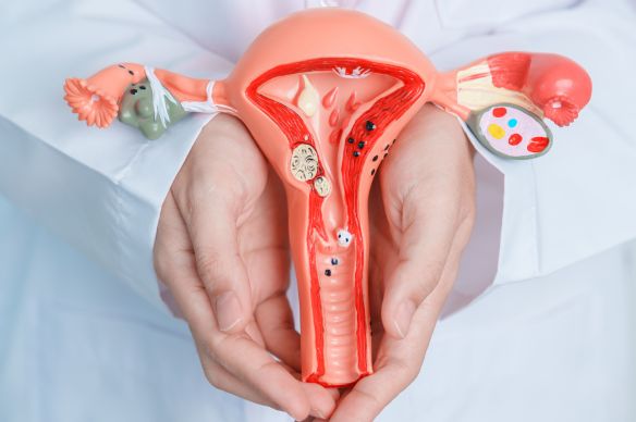 miomas uterinos